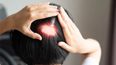 Hair Disorder Treatments