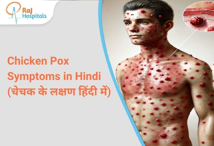 Chicken Pox Symptoms in Hindi